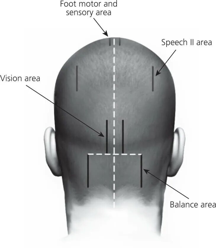 краниопунктура воздействие на зоны головы. зоны краниопунктуры на голове. краниопунктура воздействие на зоны. какой автор предложил краниопунктуру скальптерапию. какой автор предложил краниопунктуру скальптерапию.