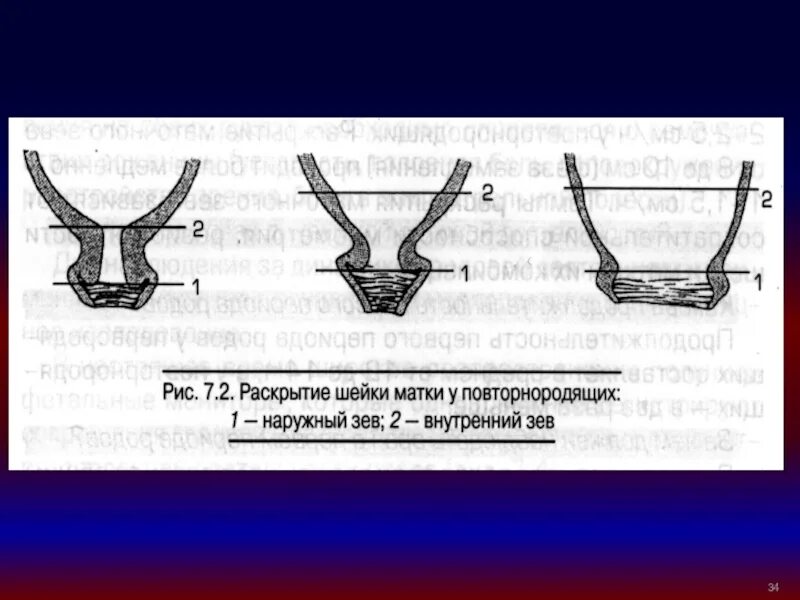 Полное раскрытие шейки матки. Раскрывается шейка матки. Внутреннее раскрытие шейки матки. Наружный и внутренний зев. Сколько пальцев рожают