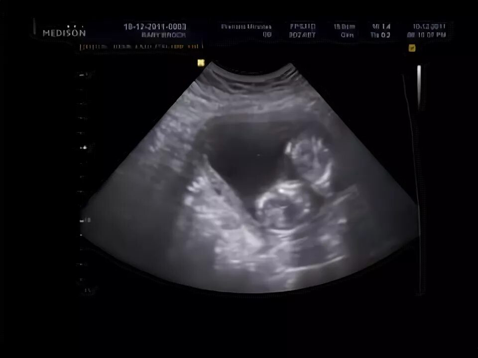 10 недель близнецы. УЗИ двойняшек на 20 неделе беременности. УЗИ двойни на 14 неделе беременности. УЗИ двойняшек 10 недель.