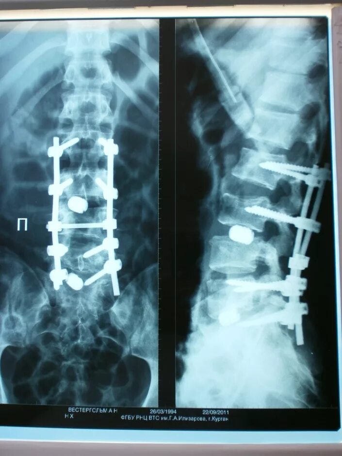 Операция смещение позвоночника. Передний спондилодез l5. Задний спондилодез l5 l6. Кейдж передний спондилодез. Транспедикулярная фиксация поясничного отдела позвоночника рентген.