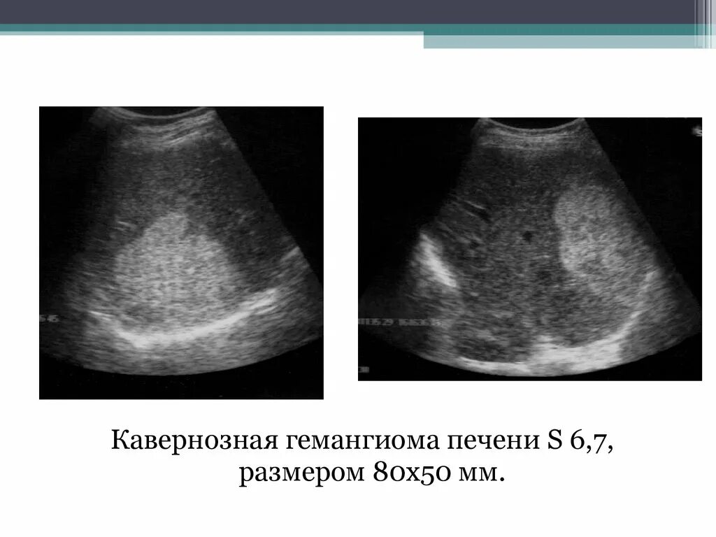 Очаговые гемангиомы печени. Кавернозная гемангиома печени на УЗИ. Гистогенез гемангиомы печени. Гемангиомы печени при УЗИ характеризуются. Капиллярная гемангиома печени на УЗИ.