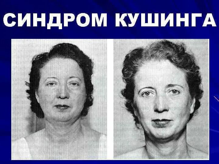Преднизолон синдром кушинга. Кушинг синдром кушинга. синдром иценко-кушинга лицо.