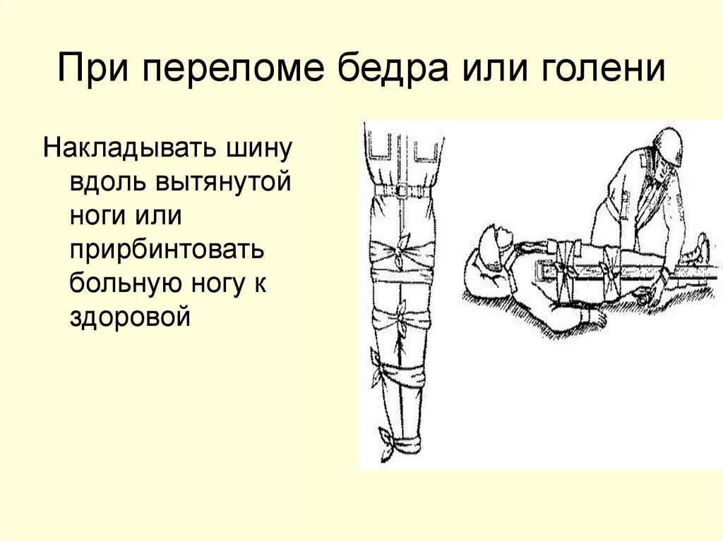 Помощь при открытом переломе бедра. Шина при переломах бедра и голени. Наложение шины на сломанную конечность.