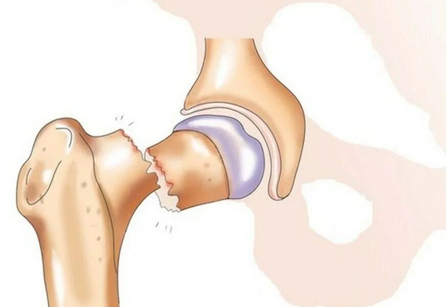 Тазобедренный сустав перелом шейки бедра. Открытый перелом шейки бедра. Вколоченный перелом тазобедренного сустава. Субтотальный перелом шейки бедра. Врач шейка бедра