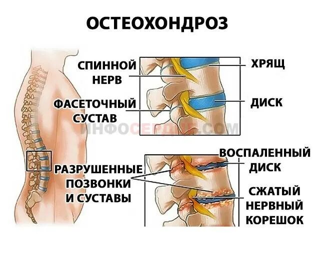 Боль в спине защемление нерва. Зажатие нерва в позвоночнике. Защемление в грудном отделе позвоночника. Защемление позвонков в пояснице. Зазимоннин неова в позвоночнике.