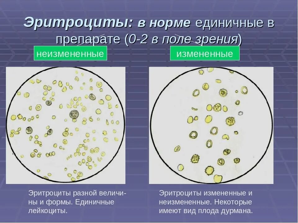 Что такое повышенные эритроциты в моче. Что такое повышенные эритроциты в моче