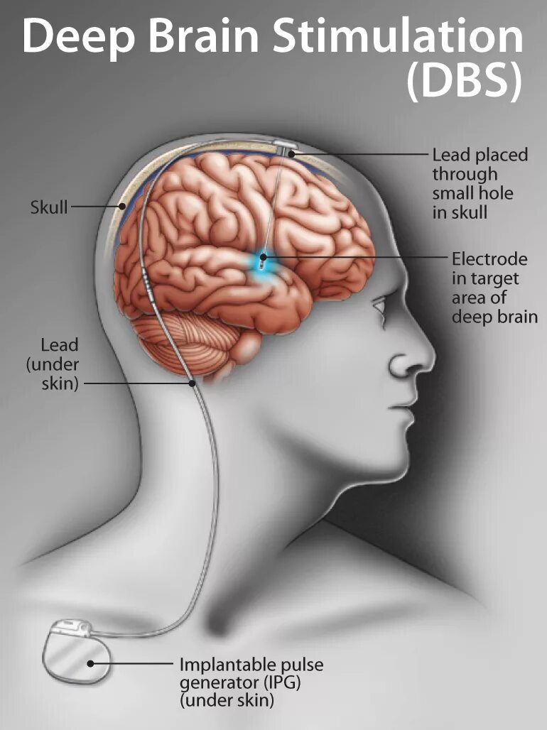 Deep brain. Глубокая стимуляция мозга. Глубинная стимуляция головного мозга.