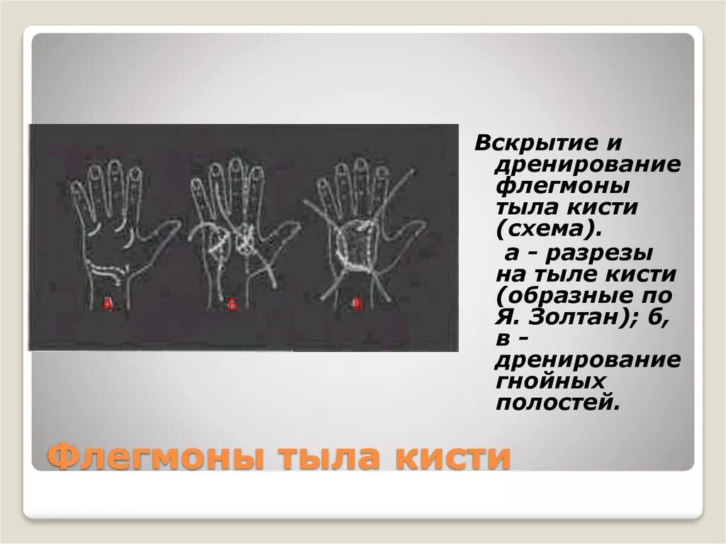 Линии разрезов при вскрытии флегмон предплечья. Разрезы при флегмонах кисти. u образная флегмона кисти. дренирование флегмоны кисти.