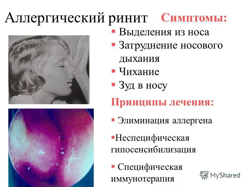 Симптомы насморка у взрослых. Симптомы аллергического ринита. аллергический ринит проявления. аллергический ринит симптомы.