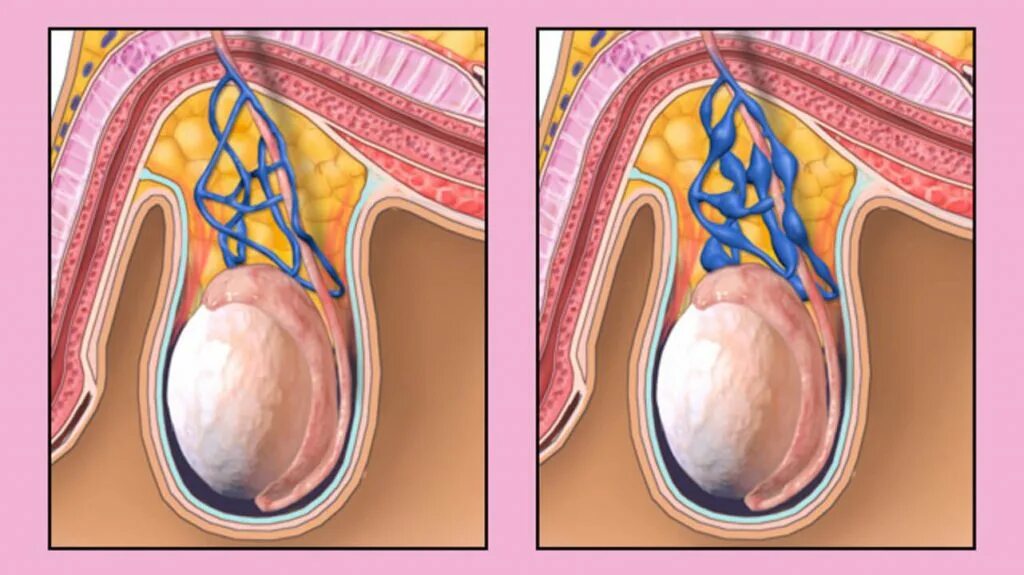 Нормальная яичка мужчин. Варикоз вен семенного канатика. Варикозное расширение вен семенного канатика (варикоцеле. Расширение вен мошонки (варикоцеле). Варикоцеле — варикозное расширение вен яичка и семенного канатика..