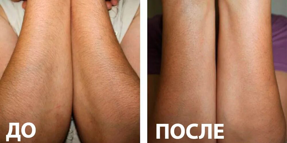 Эпиляция ея. Лазерная эпиляция elos. лазерная эпиляция результат. результаты лазерной эпиляции до и после.