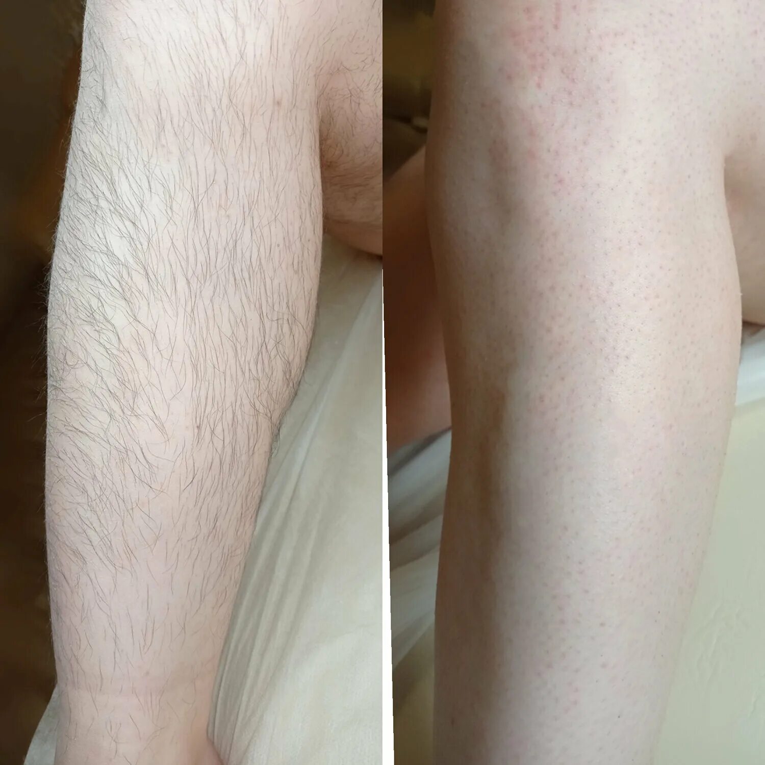 Домашний шугаринг сахаром. Протокол процедуры восковой депиляции. Шугаринг в домашних условиях. Уроки депиляции воском. Уроки депиляции воском.