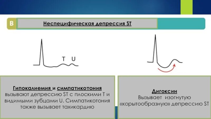 Эпизод депрессии st. Корытообразная депрессия сегмента St. Депрессия сегмента St на ЭКГ типична для. Косонисходящая депрессия сегмента St. Корытообразная депрессия сегмента St на ЭКГ.