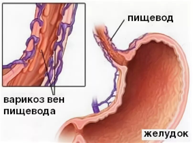 Варикозные вены пищевода мкб 10