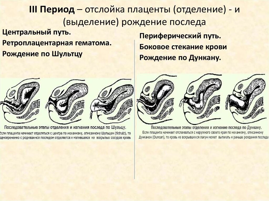 Роды 9 часов. Механизм отслойки плаценты. 3 Период родов отделение плаценты. Механизм отделения плаценты по Шульце. Типы отделения последа.