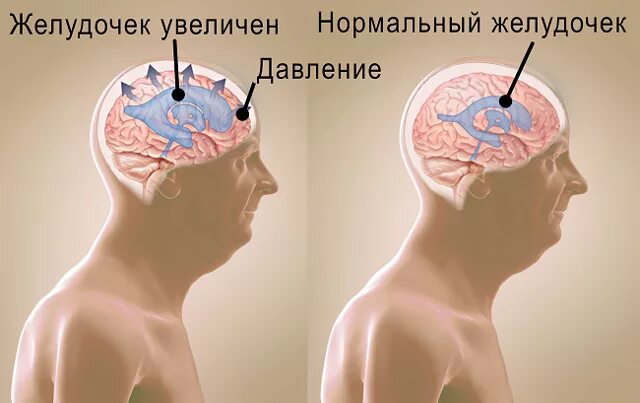 Внутричерепное давление головного мозга. Клинические симптомы гидроцефалии. Шунтированная гидроцефалия. Шунт головной мозг ликвора. Давление Черепного мозга.