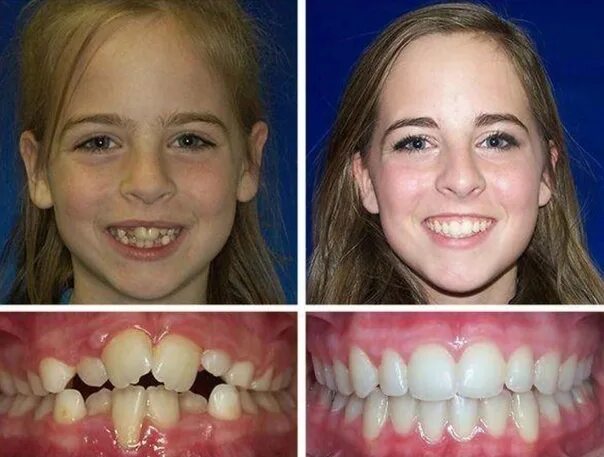 Почему зубы стали кривыми. Неправильный прикус ортодонт. Не ровние передние зубы. Почему зубы стали кривыми. Почему зубы стали кривыми.