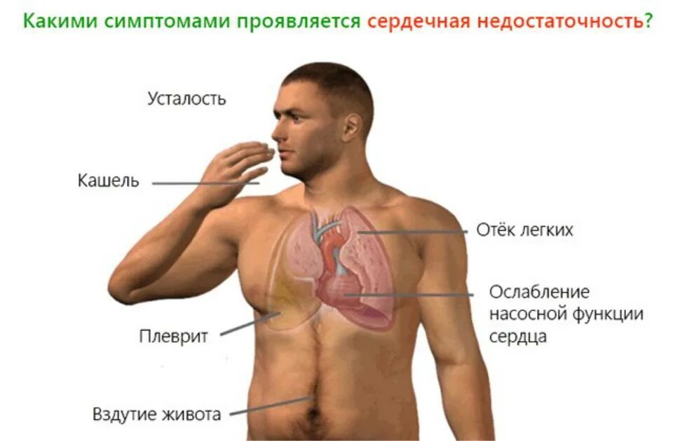 Признаки большого у мужчин. Симптомы при сердечной недостаточности. Сердечная недостаточность симптомы. Сердечная недостаточность симпт. Признаки сердечной недо.