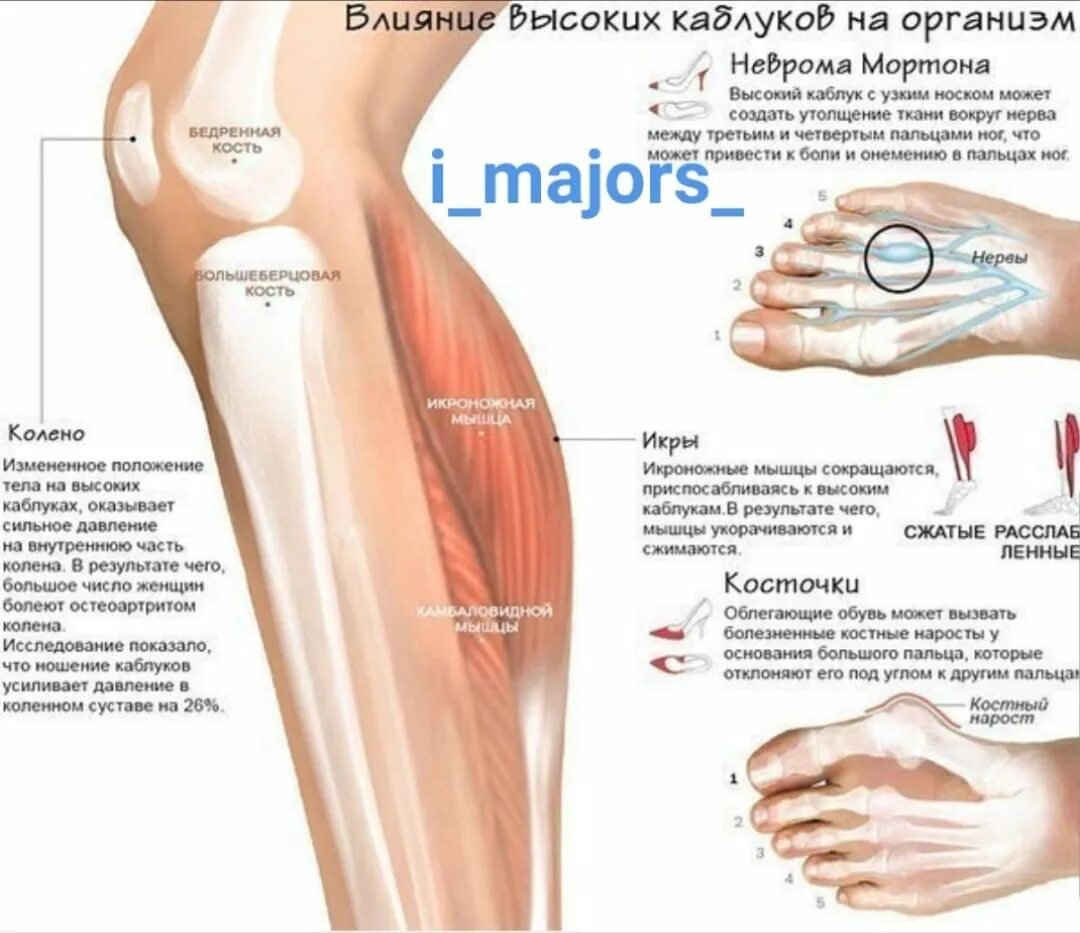 Ноги выше колена. Болит колено с внутренней стороны. Влияние каблуков. Влияние каблуков на организм. Болит под коленкой с внутренней стороны.