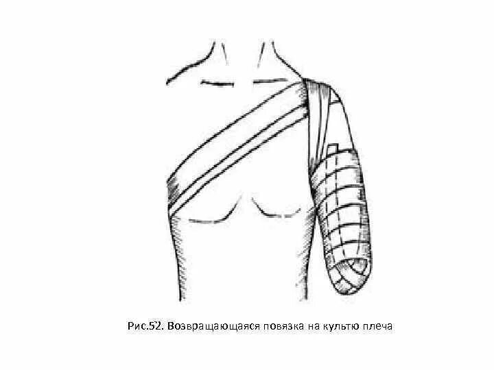 Наложение повязки варежка алгоритм. Десмургия повязка возвращающаяся. Наложение возвращающейся повязки на культю. Техника наложения повязки на культю. Возвращающаяся повязка на культю бедра.