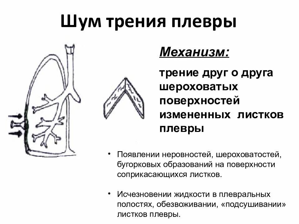 Хрипы при пневмонии у взрослых