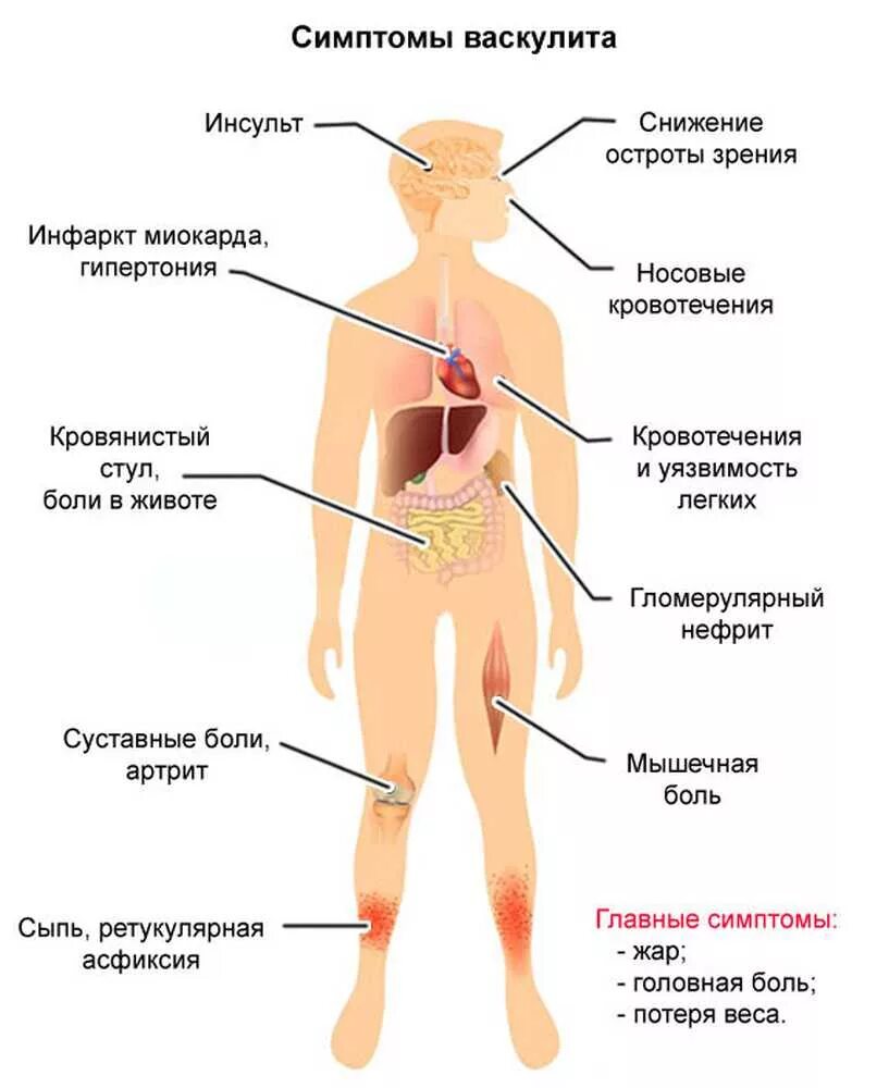 Мужчину возбуждают ноги. Васкулит сосудов проявление. Геморрагический васкулит. Геморрагический васкулит симптомы. Геморрагический васкулит сыпь.