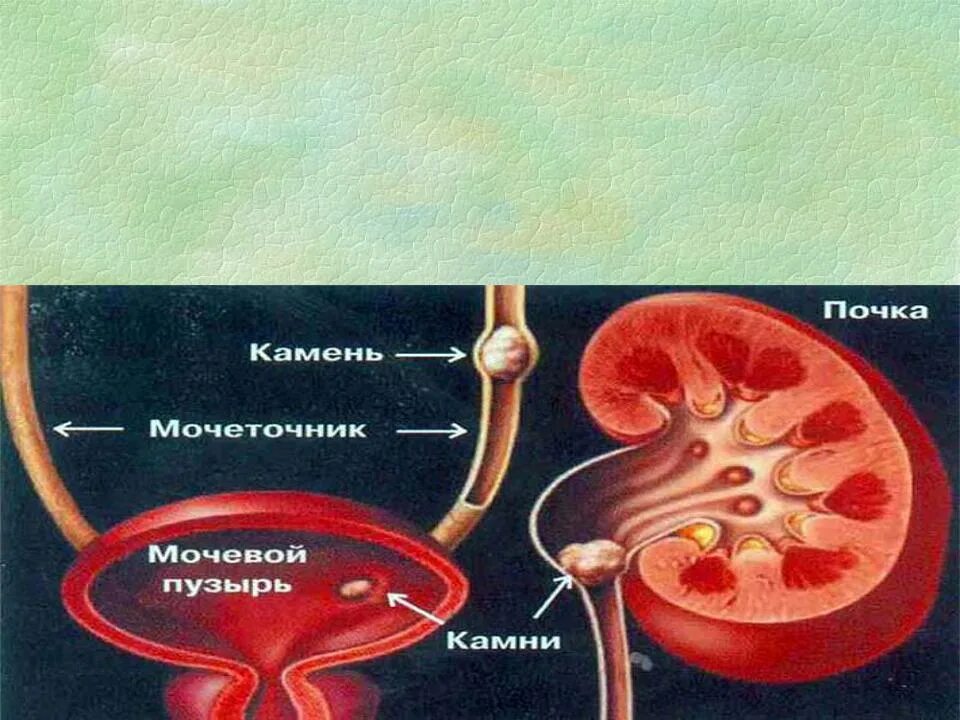 Острые почечные заболевания. Постренальная почечная недостаточность. Острая почечная недостаточность почка. Преренальная острая почечная недостаточность. Постренальная острая почечная недостаточность развивается при.