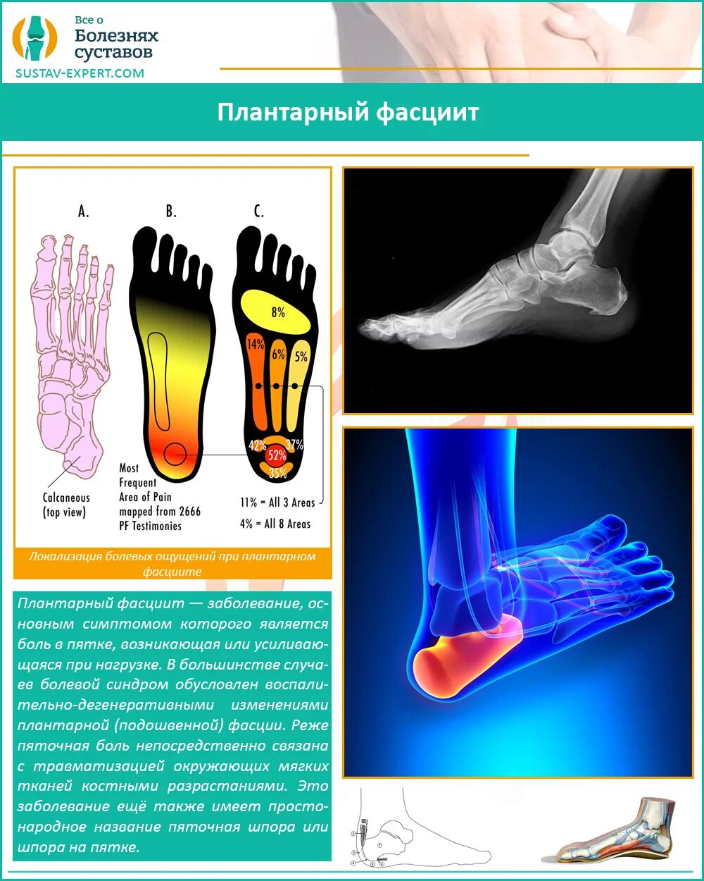 Фасцит в пятке. Плантарный фасциит стопы. Плантарный фасциит терапия. Подошвенная шпора симптомы.