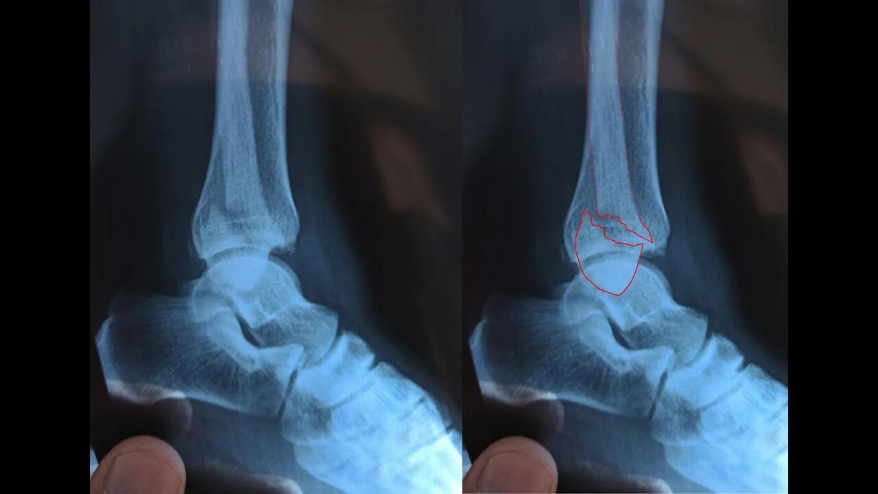 Перелом со смещением нужна операция. Перелом латеральной лодыжки рентген. Трехлодыжечный перелом рентген. Трехлодыжечный перелом голени. АВУЛЬСИВНЫЙ перелом наружной лодыжки.