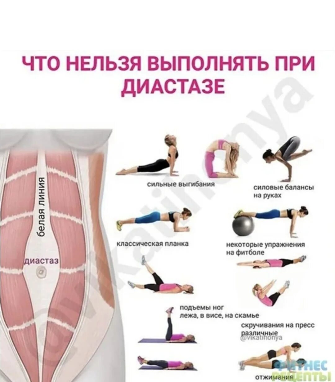 Какие упражнения делают при диастазе. Диастаз мышц живота 1 степени. диастаз прямых мышц живота упражнения. упражнения при диастазе мышц живота.