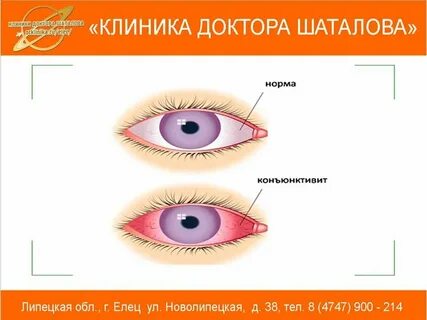Можно ли при конъюнктивите