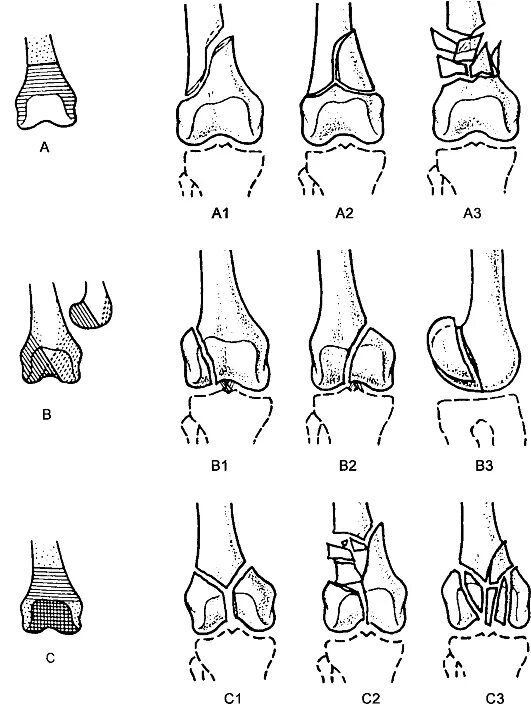 Повреждение медиального мыщелка. Перелом латерального мыщелка большеберцовой кости классификация. Краевой перелом мыщелка бедренной кости. Перелом мыщелка плечевой кости у собак. Латерального мыщелка бедренной кости.