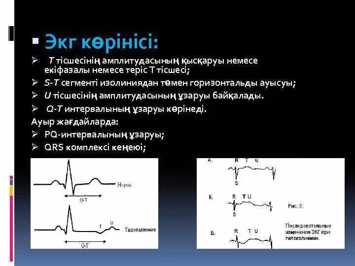 Как установить экг. Экг при декстрокардии у детей. электроды экг при декстрокардии. декстропозиция сердца на экг. расположение электродов экг при декстрокардии.