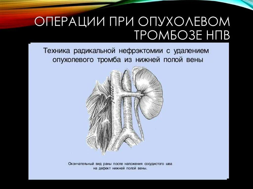 Операции при тромбозе