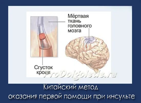 Что значит тяжелое состояние при инсульте. Кровопускание при инсульте. китайский способ помощи при инсульте. первая помощь при инсульте кровопускание. при инсульте первая помощь проколоть.