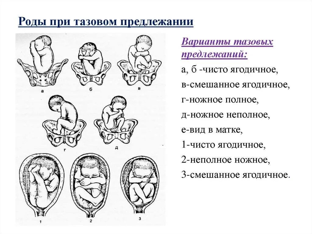 Полное предлежание форум. Головное ножное предлежание плода. Тазовое предлежание плода роды. Продольное предлежание плода ягодичное 2 позиция вид. Положение продольное предлежание тазовое ягодичное 2 позиция.