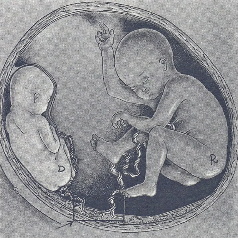 Акушерские и эмбриональные недели. Многоплодная беременность плацента. Многоплодная беременность пуповина. Патологии многоплодной беременности. Аномалия многоплодной беременности.