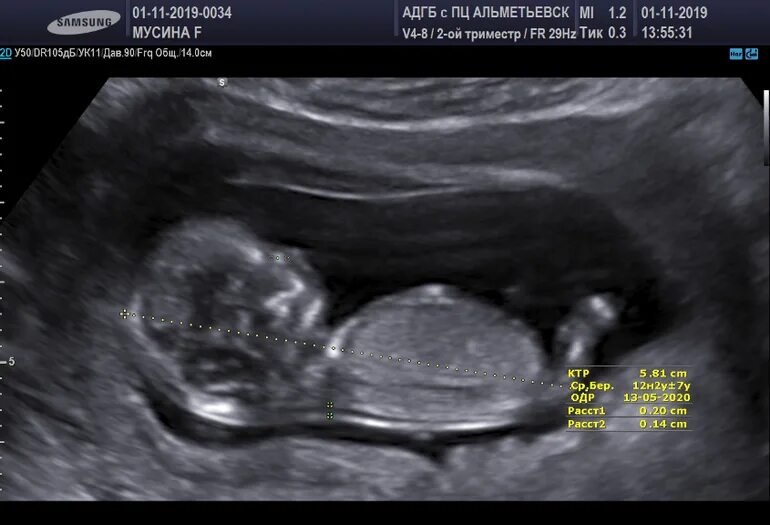 Твп 1. Узи воротниковой зоны плода норма. Измерение твп плода на узи. Твп на узи 11 недель. Твп на 12 неделе беременности норма таблица.