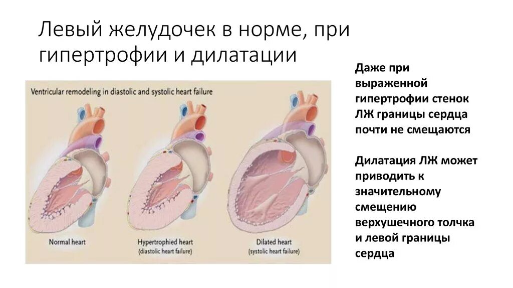 Заболевания левого желудочка. Дилятация полости левого желудочка. Гипертрофия левого желудочка сердца показатели. Дилатация желудочков сердца. Дилатация правого желудочка симптомы.