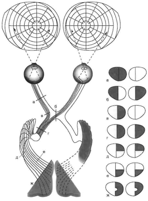 Монимен. Зрительный нерв неврология схема. Выпадение полей зрения периметрия. Периметрия гемианопсия. Выпадение полей зрения при поражении зрительного нерва.