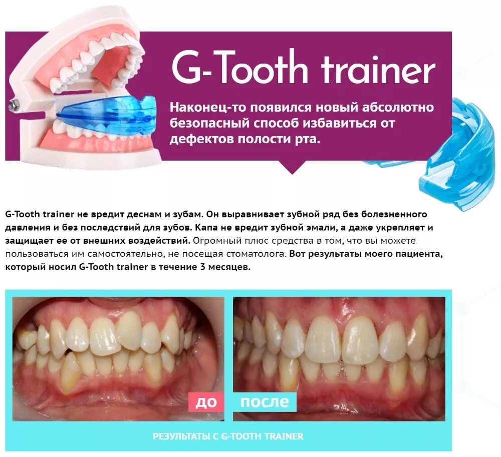 Капы для зубов отзывы. Капа Dental Trainer. Трейнеры для выравнивания зубов. Капы для выравнивания зубов. Трейнер для исправления прикуса.