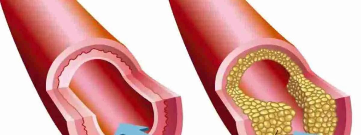 Холестериновые бляшки в сосудах. Атеросклеротические бляшки в сосудах. Как проверить сосуды на тромбы и холестериновые