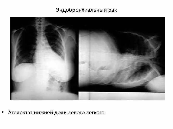 Дисковидный ателектаз рентген. Ателектаз доли рентген. Ателектаз верхней доли правого легкого на рентгене. Сегментарный ателектаз рентген. Ателектаз нижнего легкого