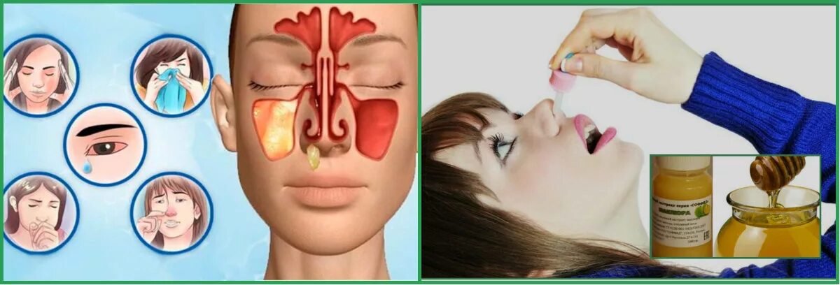 Острый Гнойный риносинусит. Как лечить дома гайморит быстрые и эффективные