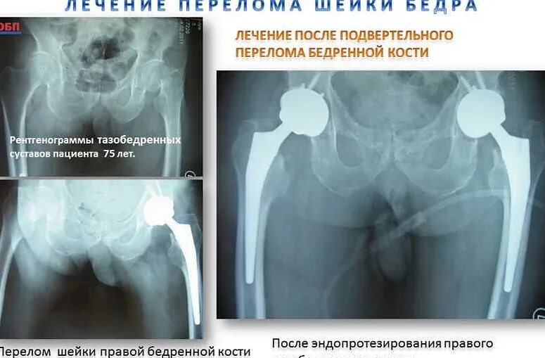 Перелом шейки бедра в пожилом возрасте. Перелом шейки бедра у пожилых. Перелом шейки бедра у пожилых операция.