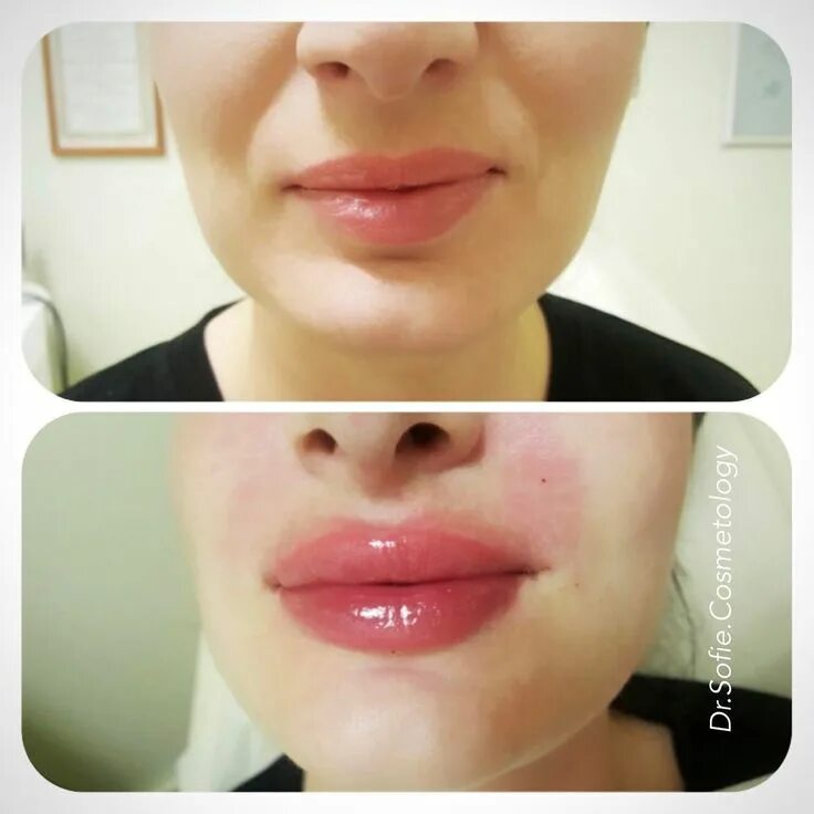 Увеличение губ lips. Накаченные губы Эстетика.