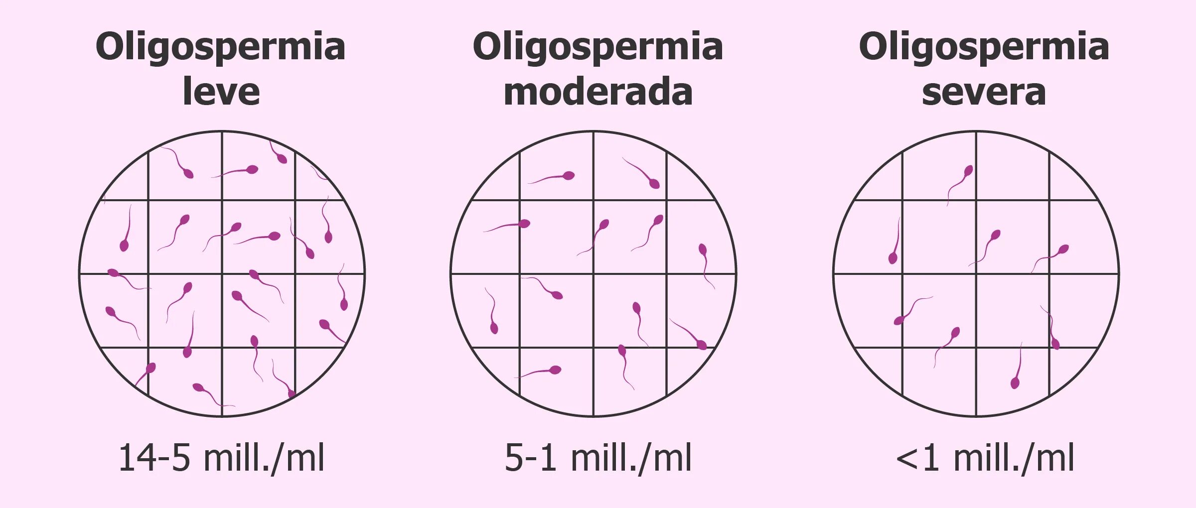 Низкая концентрация сперматозоидов. Причины олигоспермии. Олигоспермия это. Спермограмма олигоспермия. Олигоспермия причины.
