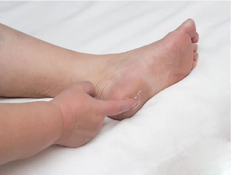 Плантарный фасциит стопы рентген. Как выглядит пятка на ноге. Как выглядит пятка на ноге. Плантарный фасциит рентген. Сквамозная эпидермофития ног.