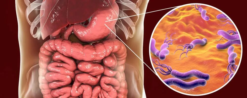 Гастрит желудок хеликобактер. Горечь во рту хеликобактер. Эрадикационная терапия хеликобактер гастрит. Хеликобактер пилори резистентность. Бактериальные препараты от хеликобактер пилори.