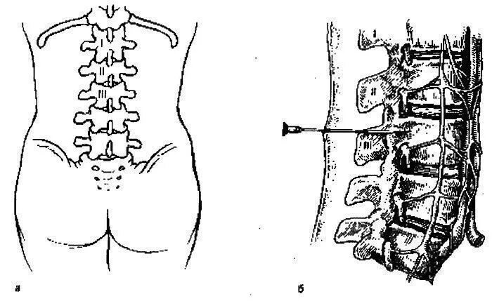 Паравертебральная поясничная блокада. Блокада корешка l5-s1 техника. Паравертебральная новокаиновая блокада. Блокада паравертебральная поясничного отдела. Паравертебральная блокада в акушерстве.